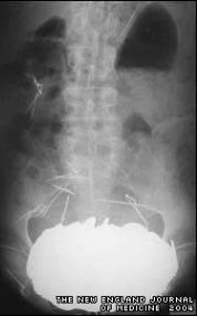 X-ray of Frenchman's stomach filled with 350 coins!