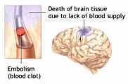 A stroke occurs when a blood vessel that brings oxygen and nutrients to the brain bursts or is clogged by a blood clot or some other mass